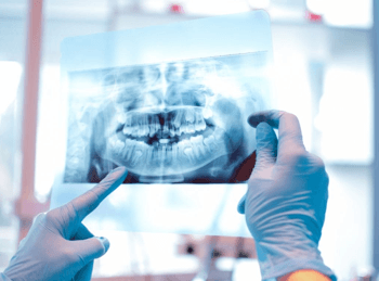 Managing Oral Side Effects of Cancer Treatment