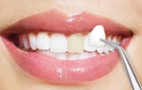 Laminate Veneers