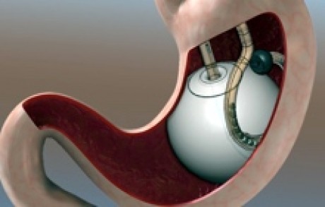 Gastric Balloon