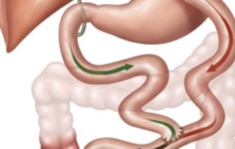 Gastric Bypass