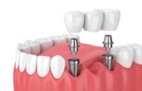 Dental Bridge