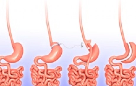 Gastric Sleeve