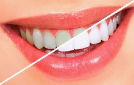 Teeth Whitening