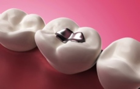 Composite Fillings