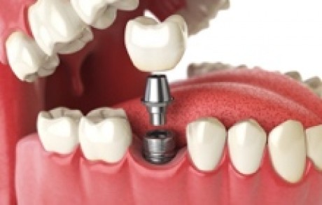 Dental Implants